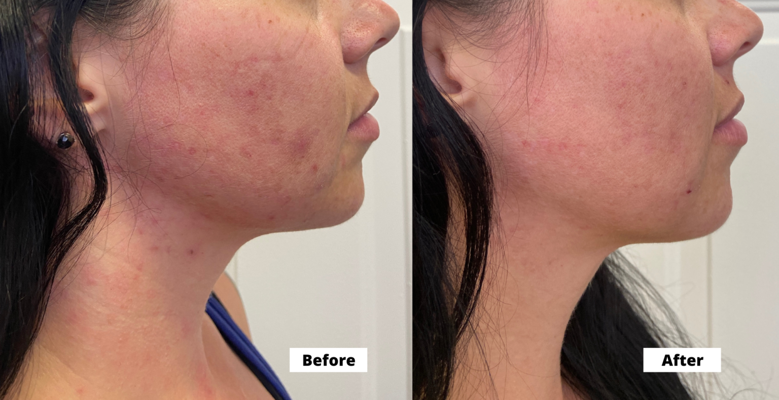 Acne Cosmetic Acupuncture Before and After Photos - Seneca Falls 