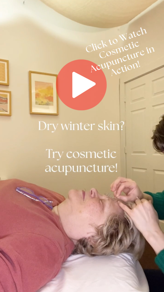 Still frame of acupuncturist Michelle Grasek giving cosmetic acupuncture to a patient in her office in Seneca Falls, with the text "Dry winter skin? Try cosmetic acupuncture!" on top of the image.